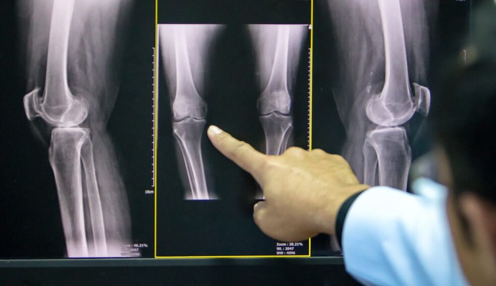a térd arthrosisának röntgenfelvétele