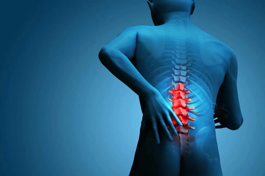 Az ágyéki gerinc osteochondrosisának fő tünete az alsó hátfájás. 
