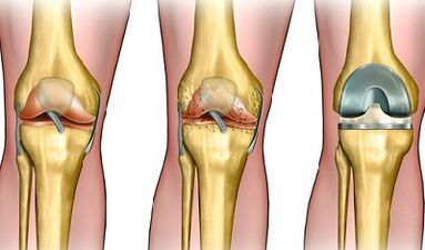 A térdízület arthrosis fejlődésének mértéke