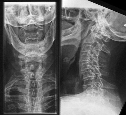 Méhnyak X -Gray - Az osteochondrosis diagnosztizálásának módszere