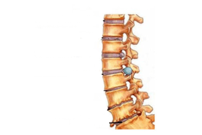 A gerinc károsodása méhnyak osteochondrosissal