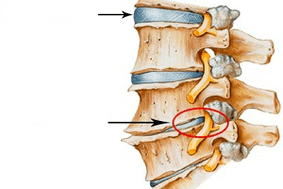 normál és sérült gerinc méhnyak osteochondrosissal
