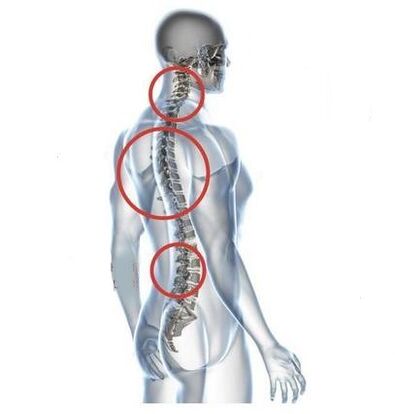 a gerinc osteochondrosisának helyei