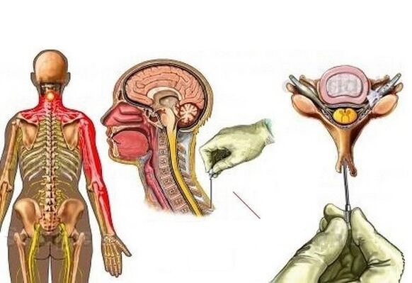 nyaki osteochondrosis kezelése akupunktúrával