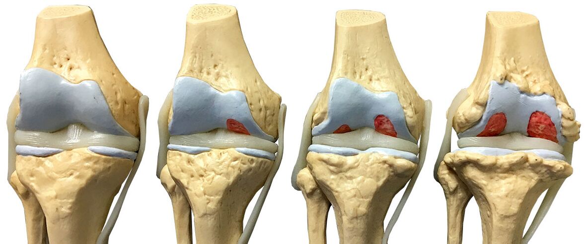 az arthrosis szakaszai