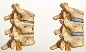 hogyan néz ki az osteochondrosis