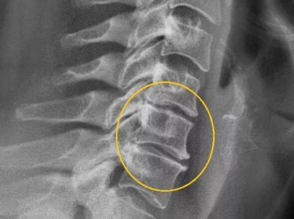 A nyaki gerinc osteochondrosisa röntgenfelvételen